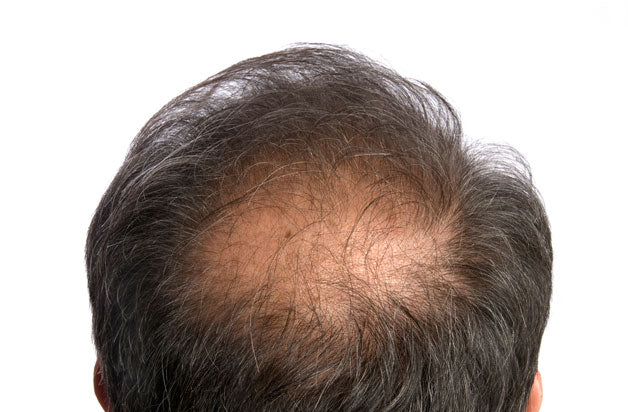 How To Grow Hair On A Bald Head Naturally