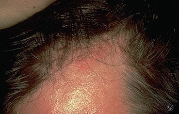 Is Seborrheic Dermatitis Hair Loss Permanent?